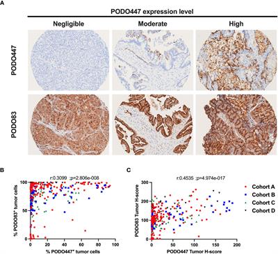 A tumor-restricted glycoform of podocalyxin is a highly selective marker of immunologically cold high-grade serous ovarian carcinoma